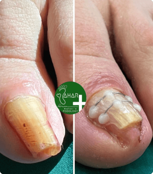 پیشگیری از ابتلا به قارچ ناخن