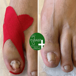 پیشگیری از ابتلا به قارچ ناخن