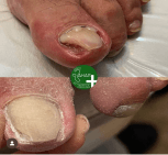 پیشگیری از ابتلا به قارچ ناخن