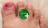 پیشگیری از ابتلا به قارچ ناخن