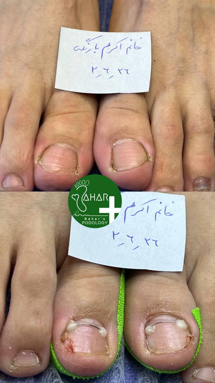 درمان فرو رفتن ناخن در گوشت